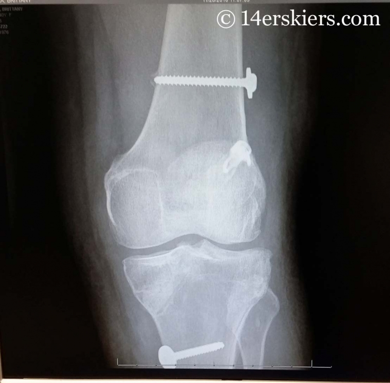 Two new screws in my knee from this ACL revision