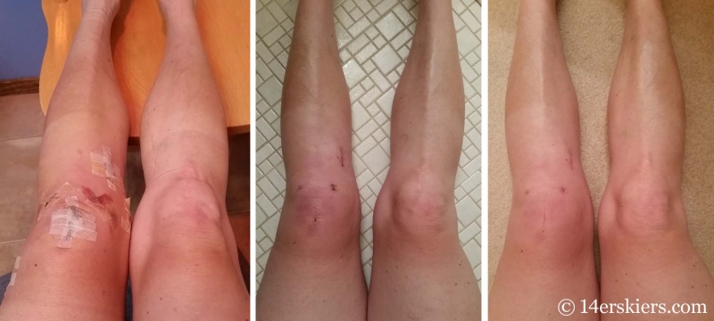 10 days, 3 weeks, and 6 weeks post-op for ACL/meniscus revision/repair