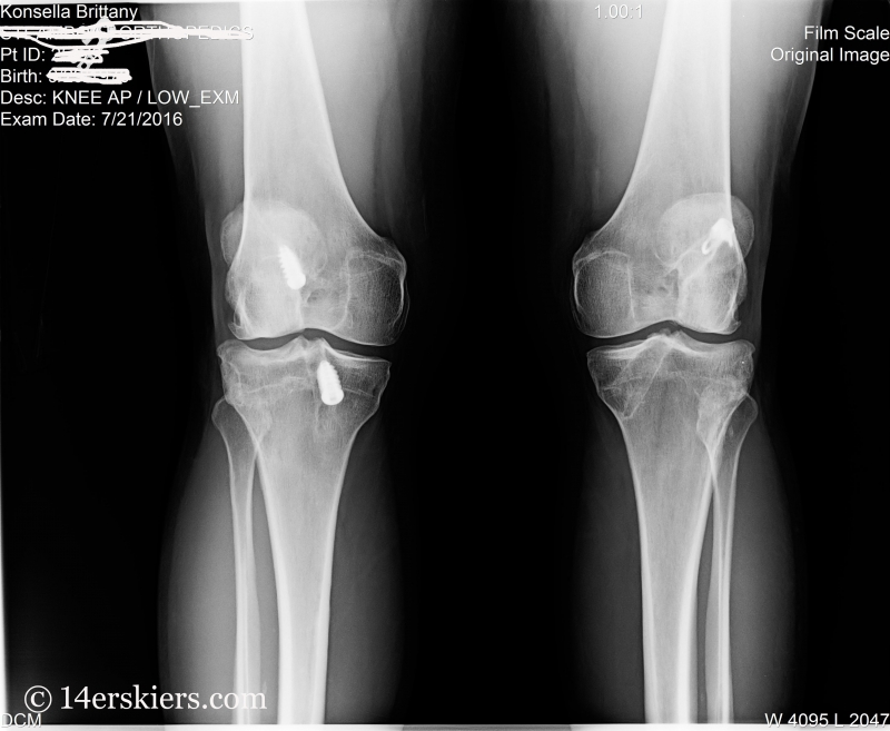 ACL reconstruction