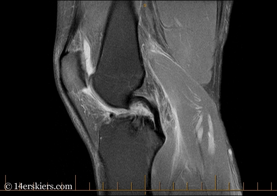 Left knee MRI image