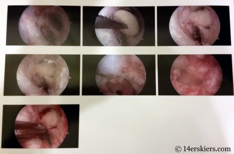 Bone graft surgery.