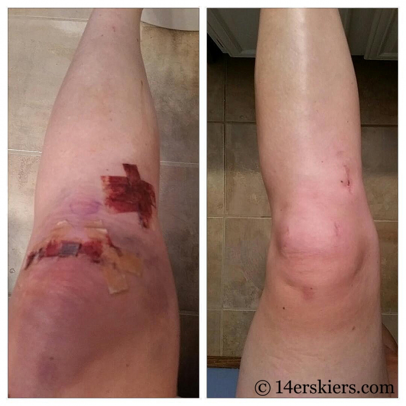 Bone graft knee surgery