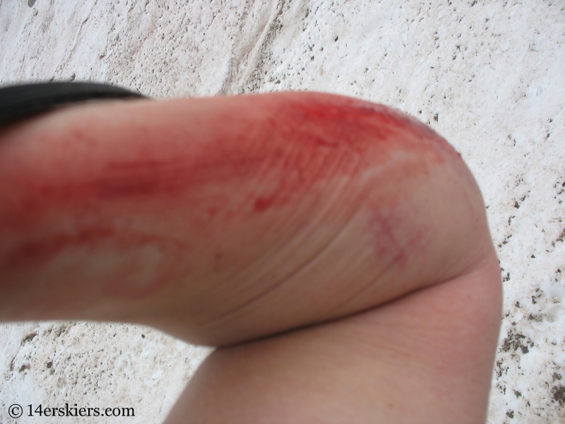 Injury while backcountry skiing - slide for life.