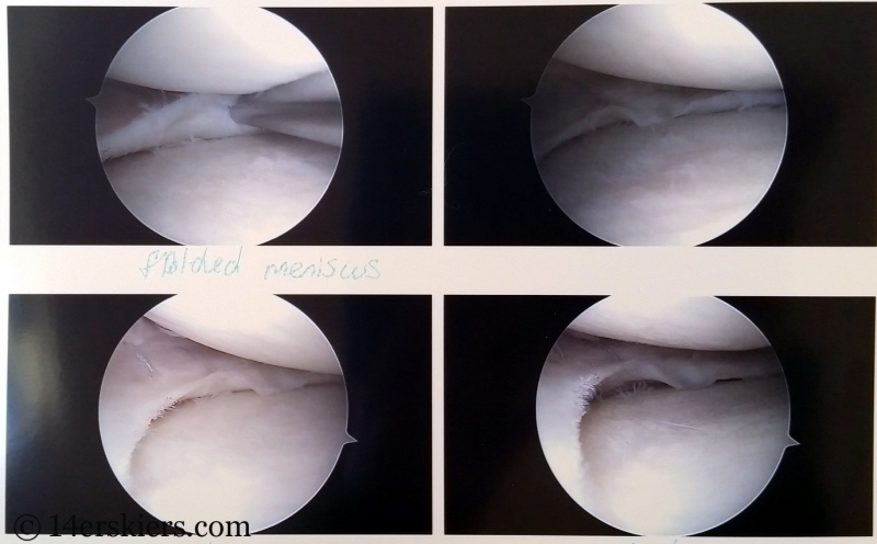 folded meniscus, then repaired (lower) with stitches.  