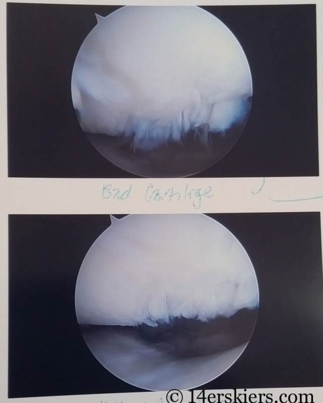My surgeon cleaned up damaged cartilage. 