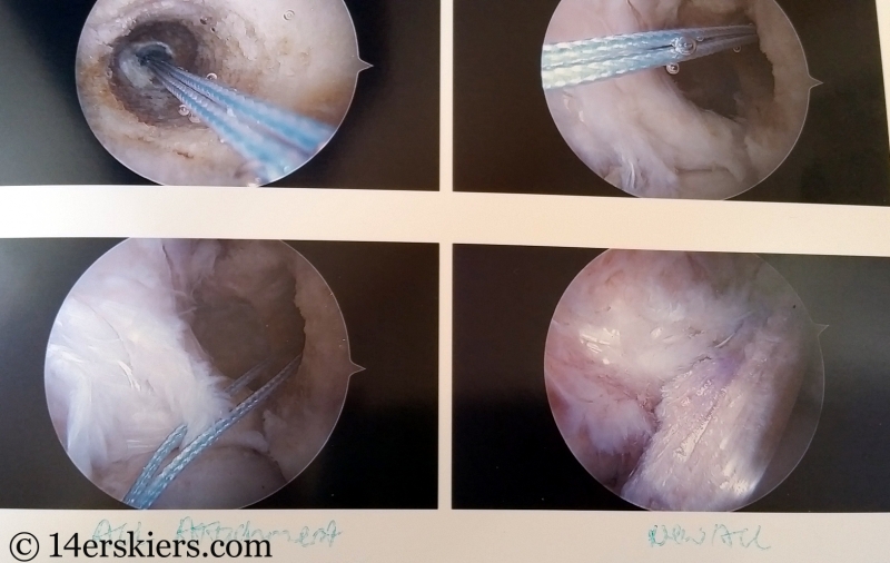 ACL graft repair with quadriceps tendon