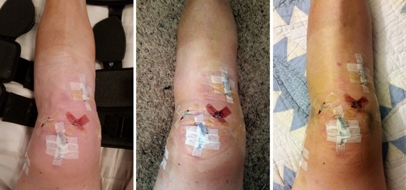 My knee 1, 4 and 7 days post-op after medial meniscus and ACL repair (quad autograft).