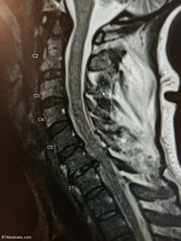 Spinal damage.  