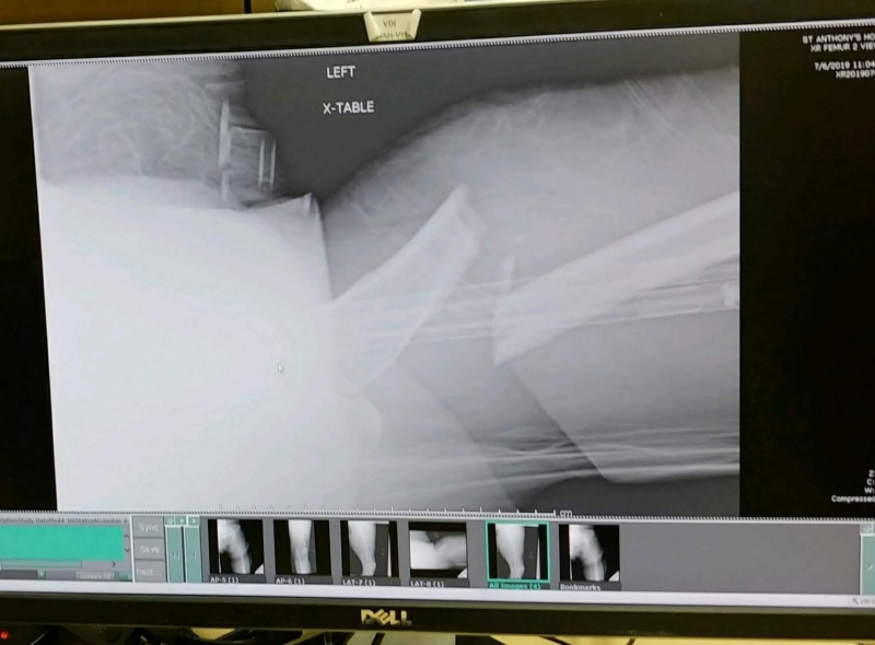 Broken femur x-ray.