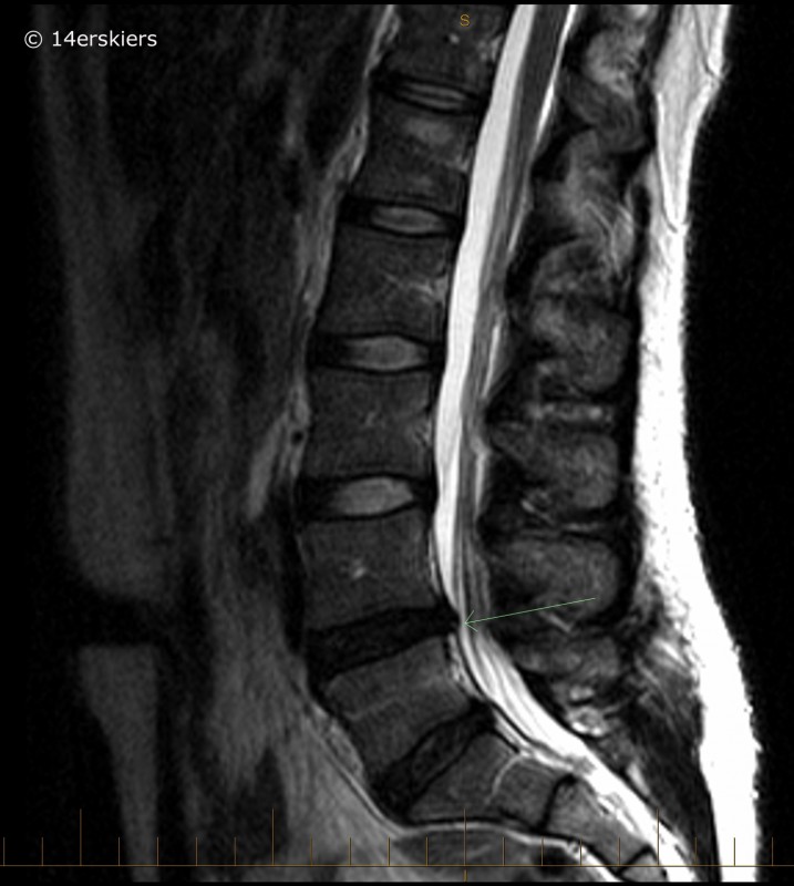 What's Worse—Bulging or Herniated Discs?