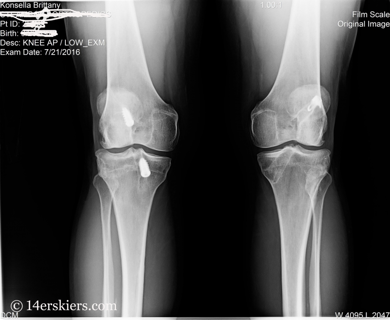 Road to Recovery: My ACL Story, version 3